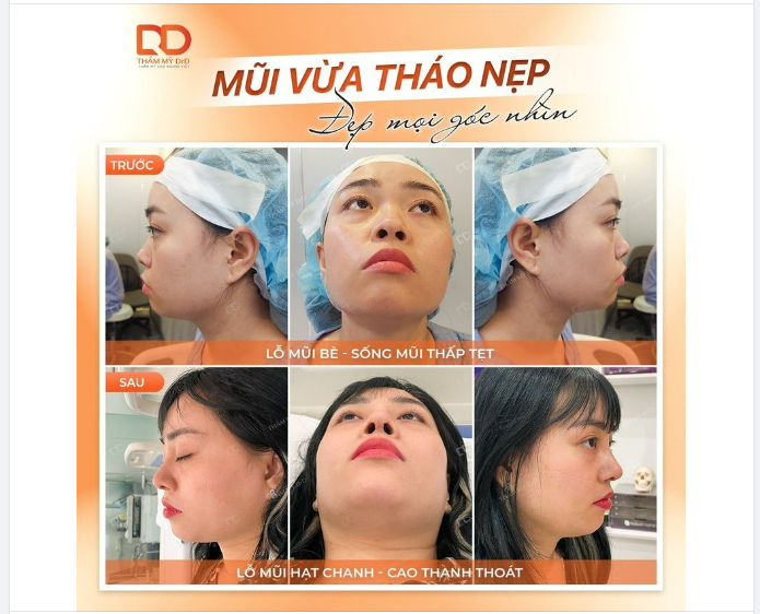 MŨI VỪA THÁO NẸP, ĐẸP XUẤT SẮC SAU 10 NGÀY