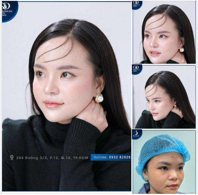 Cô gái xinh đẹp nhà Latin sau 5 tháng nâng mũi cấu trúc