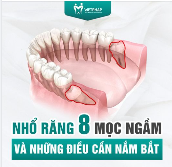 NHỔ RĂNG 8 MỌC NGẦM VÀ NHỮNG ĐIỀU CẦN NẮM BẮT
