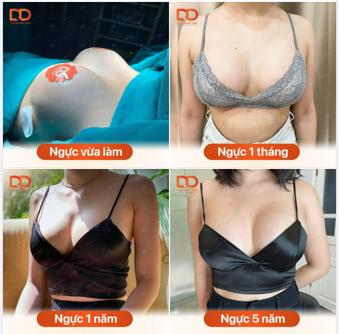 NÂNG NGỰC 1 THỜI GIAN CÓ BỊ NHỎ LẠI HAY KHÔNG?