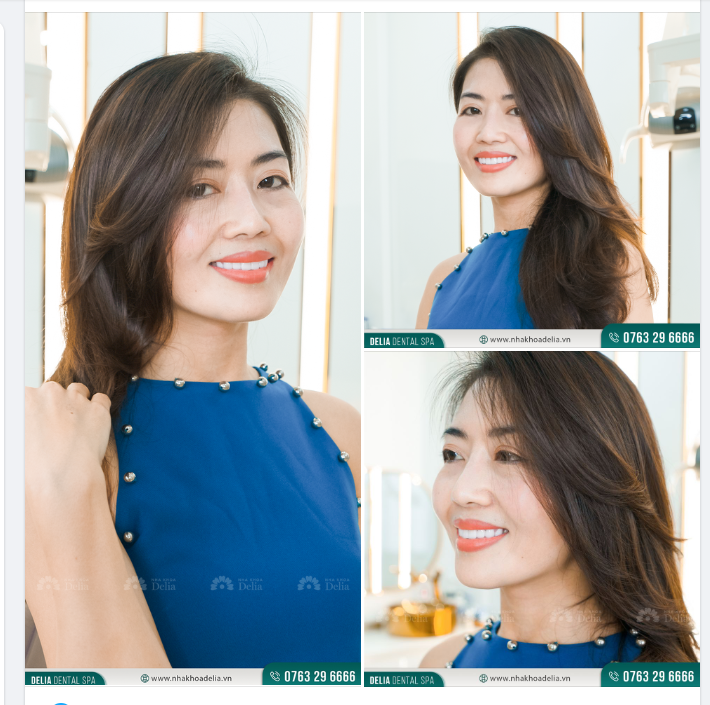 Cùng ngắm nhìn nụ cười rạng rỡ của chị Bích Huệ sau thẩm mỹ răng sứ tại Delia.