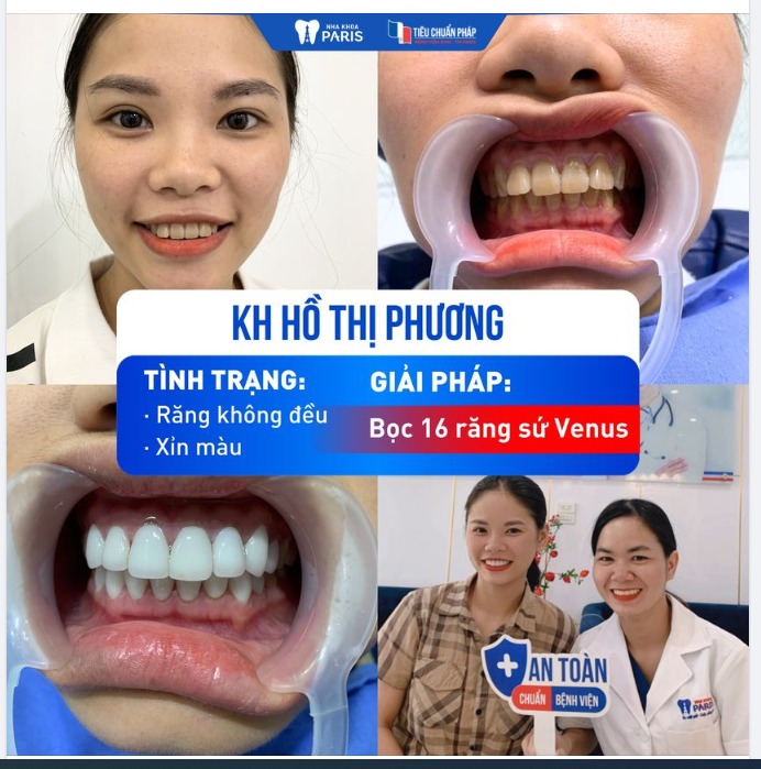 BỌC 16 RĂNG SỨ VENUS - KH HỒ THỊ PHƯƠNG TỰ TIN VỚI NỤ CƯỜI TỎA SÁNG