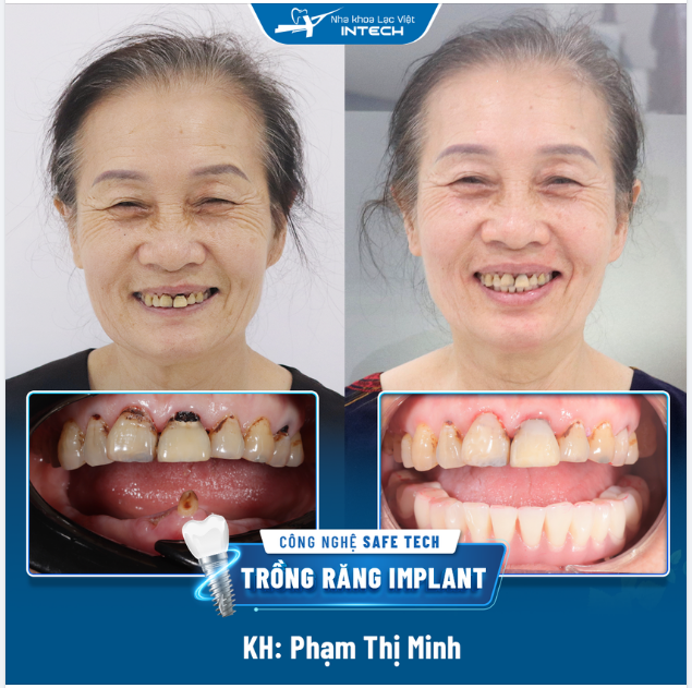 SỐNG VUI KHOẺ NHỜ TRỒNG RĂNG IMPLANT CÔNG NGHỆ SAFE-TECH