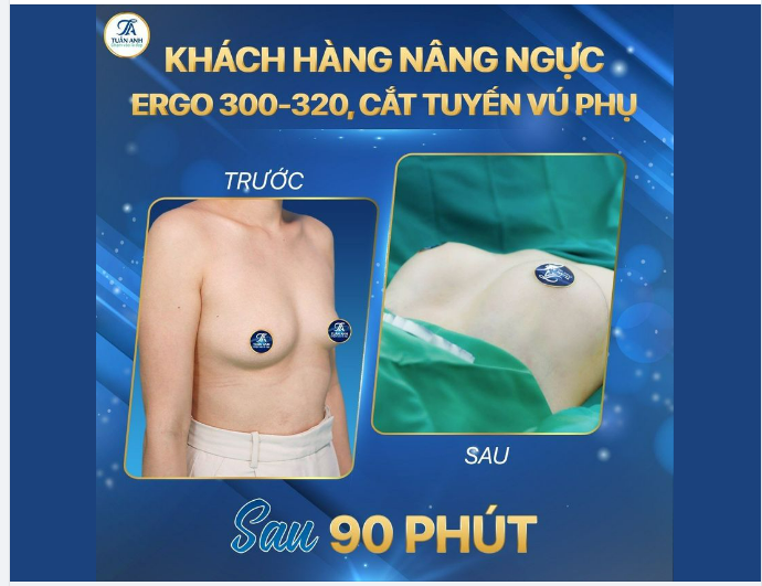THỰC TẾ KHÁCH HÀNG NỮ NÂNG NGỰC ERGO 300-320