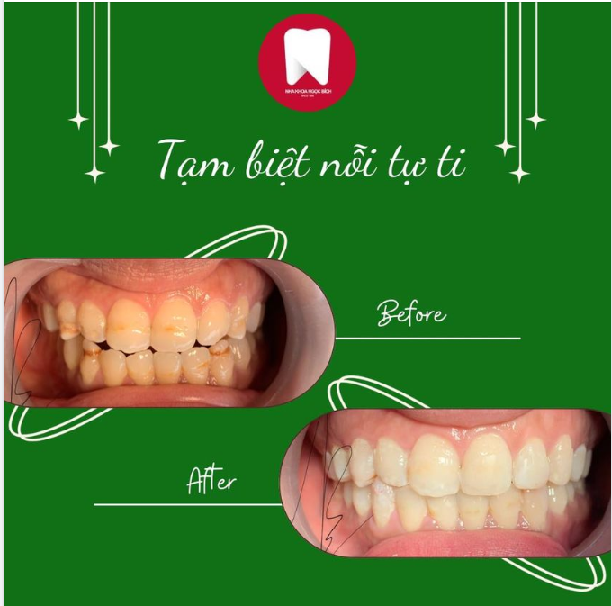 ĐÁNH BAY VẾT Ố VÀNG - NGẠI GÌ KHÔNG CƯỜI XINH