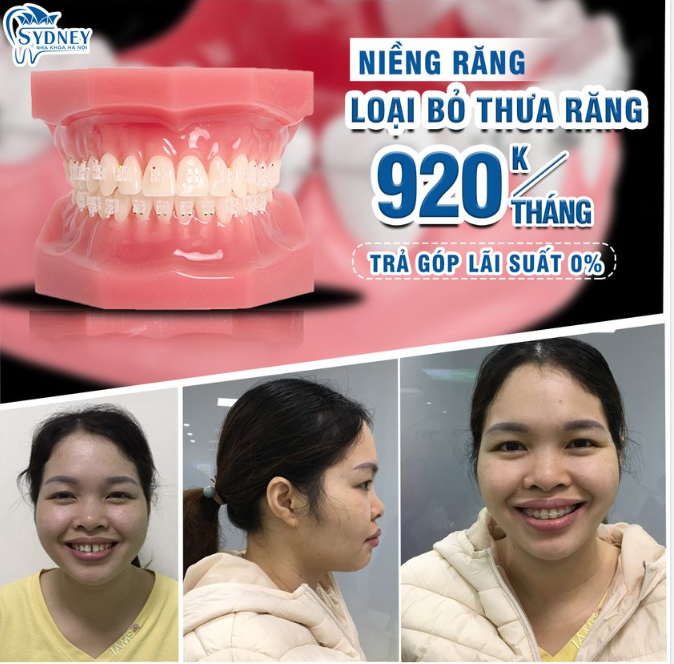 Mách bạn giải pháp khắc phục răng thưa an toàn, hiệu quả