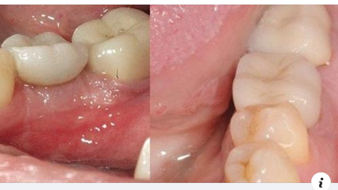 CÔNG NGHỆ PHỤC HÌNH RĂNG SỨ TRÊN IMPLANT DCT SẮP CÓ MẶT TẠI VIỆT NAM