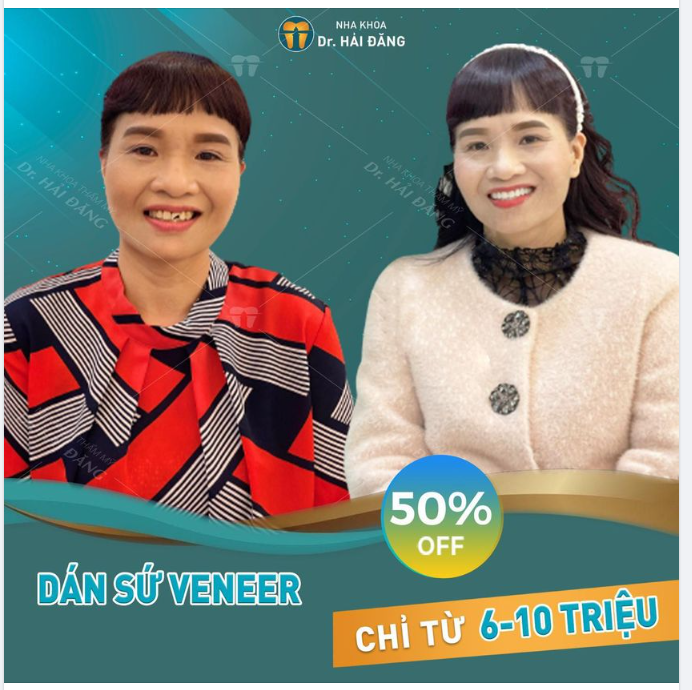 TỰ TIN TƯƠI XINH CÙNG VENEER