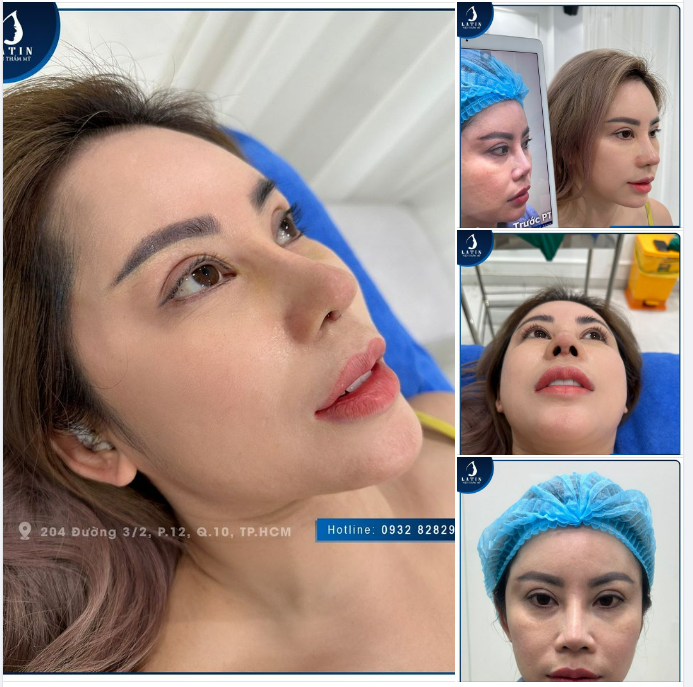 Kết quả sửa mũi như ý sau 7 ngày