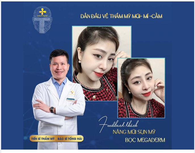 Dáng mũi S-line tự nhiên cho chị khách hàng sinh năm 1989 tại Hà Nội.