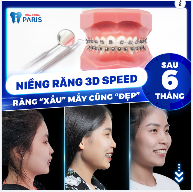 Bạn không XẤU, do bạn chưa NIỀNG RĂNG thôi