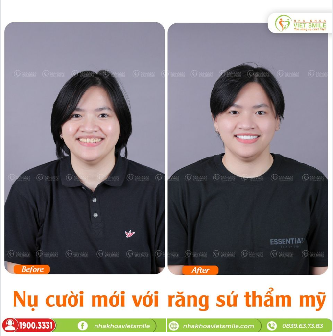 CƯỜI TỰ TIN VỚI NỤ CƯỜI MỚI SAU THẨM MỸ RĂNG SỨ