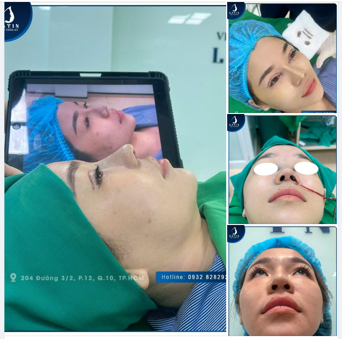 MŨI CẤU TRÚC SỬA LẠI KẾT HỢP CẮT MÍ 4D CHO KHÁCH HÀNG ĐẾN TỪ AN GIANG