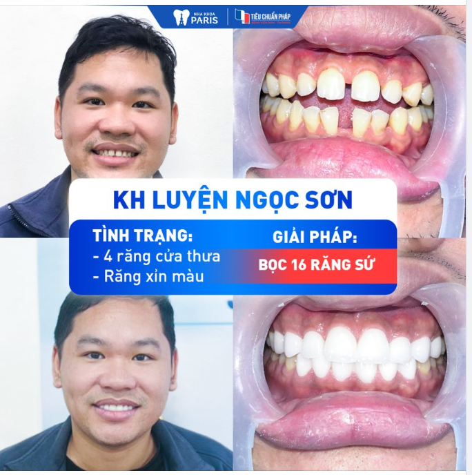 BỌC 16 RĂNG SỨ KHẮC PHỤC TÌNH TRẠNG RĂNG THƯA QUÁ NHIỀU - KH LUYỆN NGỌC SƠN