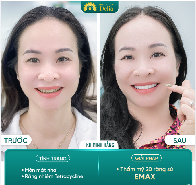 Chỉ 2 lần hẹn - Kiến tạo nụ cười trọn vẹn cho chị Minh Hằng
