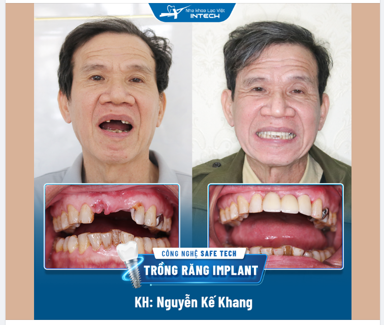 TRỒNG RĂNG IMPLANT – THAY THẾ RĂNG MẤT HOÀN HẢO