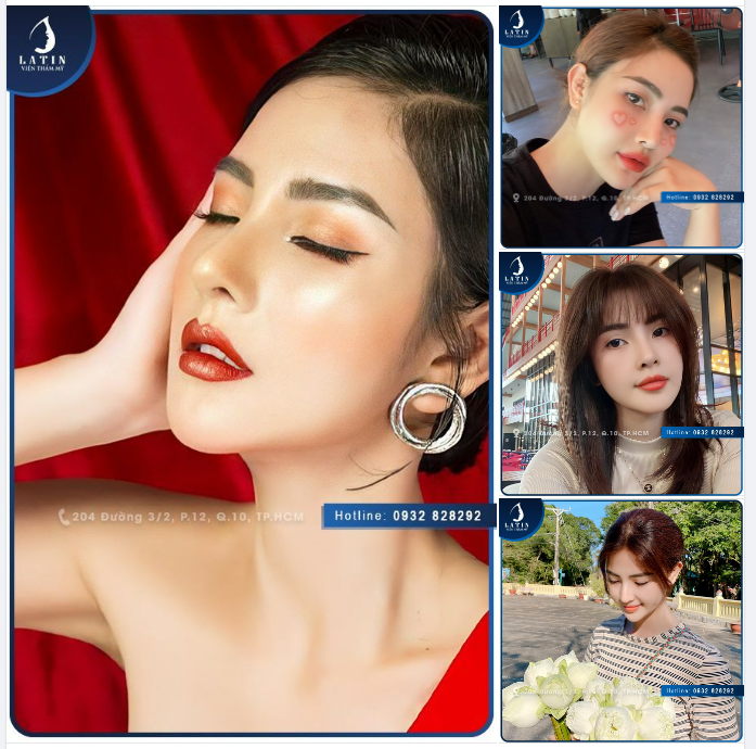FEEDBACK: MŨI TÁI CẤU TRÚC 1 NĂM TUỔI