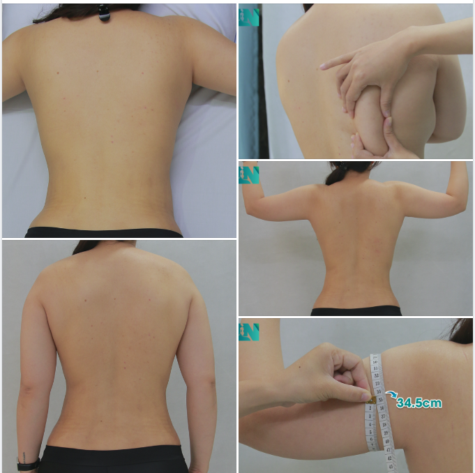  HÚT MỠ TẠO DÁNG THẨM MỸ CÁC VÙNG CÒN LẠI