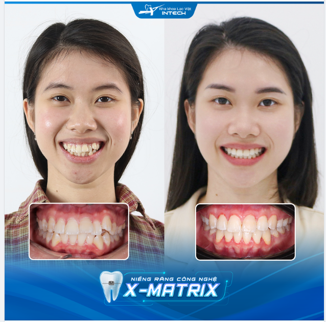 NIỀNG RĂNG X-MATRIX - TỰ TIN VỚI NỤ CƯỜI XINH