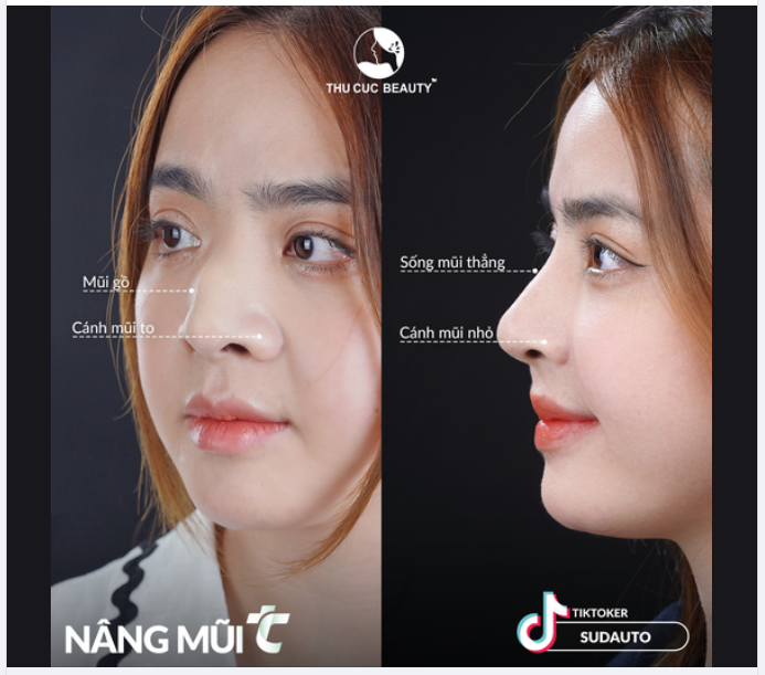 Nâng mũi giống Hoa hậu Thanh Thủy sẽ như thế nào?