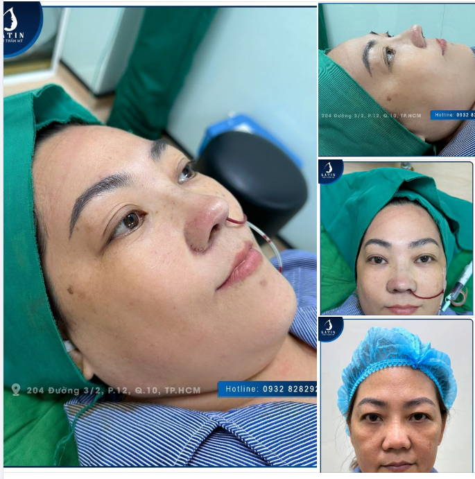 KHẮC PHỤC THÀNH CÔNG CA MŨI NÂNG HỎNG Ở NƠI KHÁC