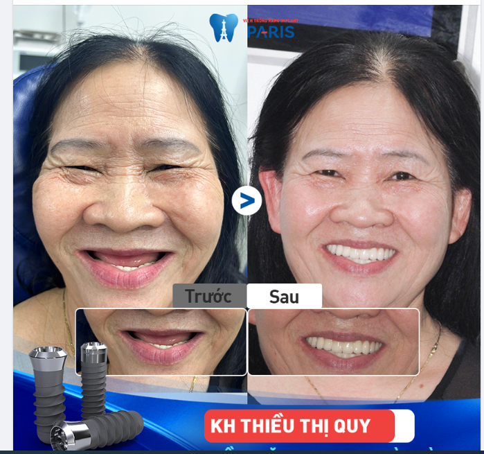 KHÔI PHỤC RĂNG TOÀN HÀM ĂN NHAI BỀN CHẮC