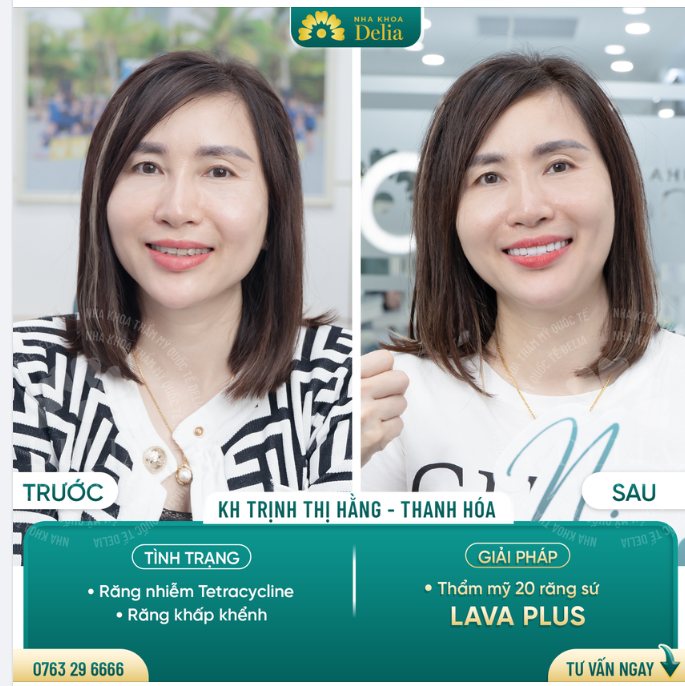 Bọc 20 răng sứ Lava Plus - KH Trịnh Hằng nở nụ cười rạng rỡ