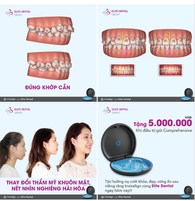 6 TIÊU CHUẨN VÀNG TRONG NIỀNG RĂNG TRONG SUỐT