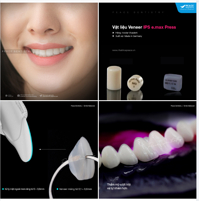 Dental Veneer - Smile makeover as the way you want.
