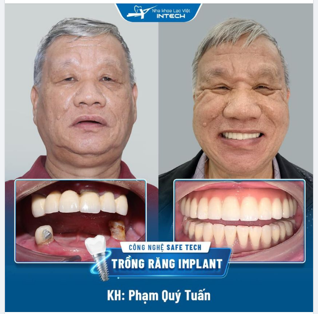 TRỒNG RĂNG IMPLANT TOÀN 2 HÀM BẰNG CÔNG NGHỆ SAFE-TECH - ĂN NGON HƠN - SỐNG KHỎE HƠN