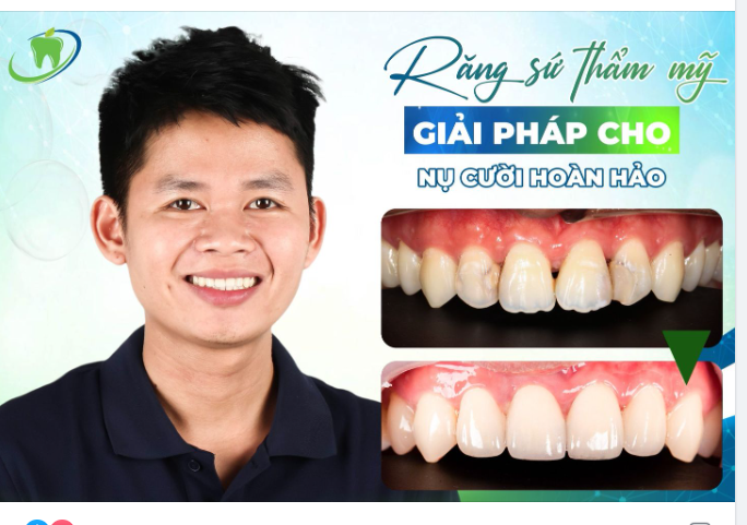 KHẮC PHỤC TÌNH TRẠNG SÂU KẼ RĂNG, HỞ TAM GIÁC ĐEN VỚI RĂNG TOÀN SỨ CAO CẤP TỪ ĐỨC