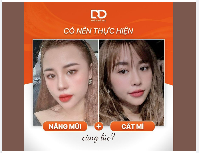 CÓ NÊN THỰC HIỆN NÂNG MŨI + CẮT MÍ CÙNG LÚC KHÔNG?