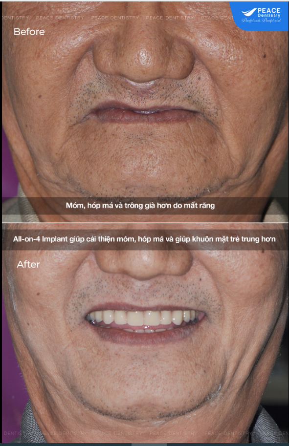 TRỒNG RĂNG TOÀN HÀM ALL-ON-4 IMPLANT