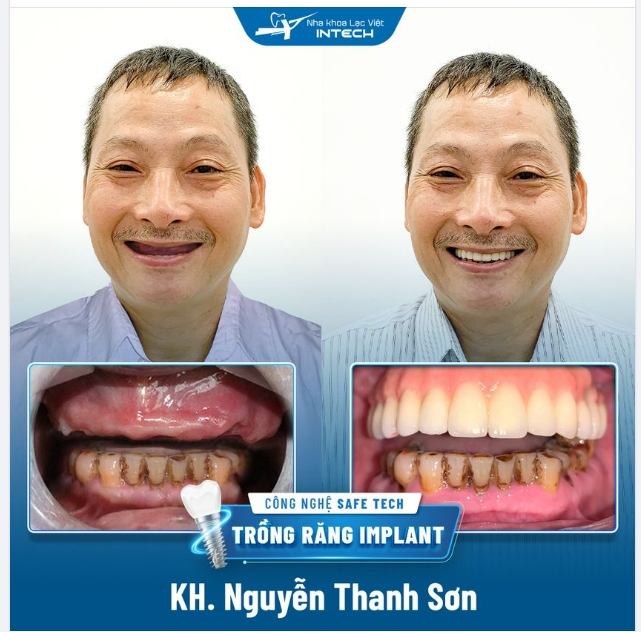 TRẺ RA 10 TUỔI NHỜ TRỒNG RĂNG IMPLANT