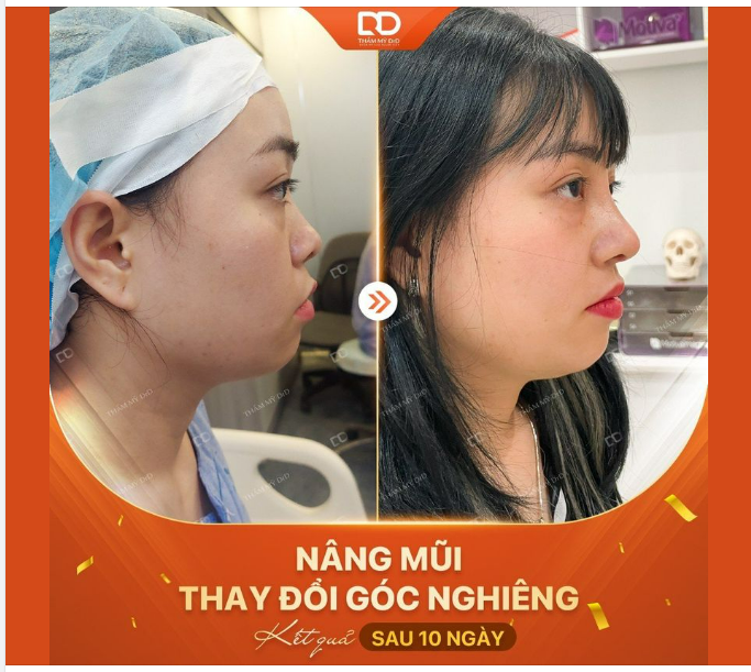 MŨI HẾT TẸT, LÃI NGAY GÓC NGHIÊNG THẦN THÁNH SAU 10 NGÀY