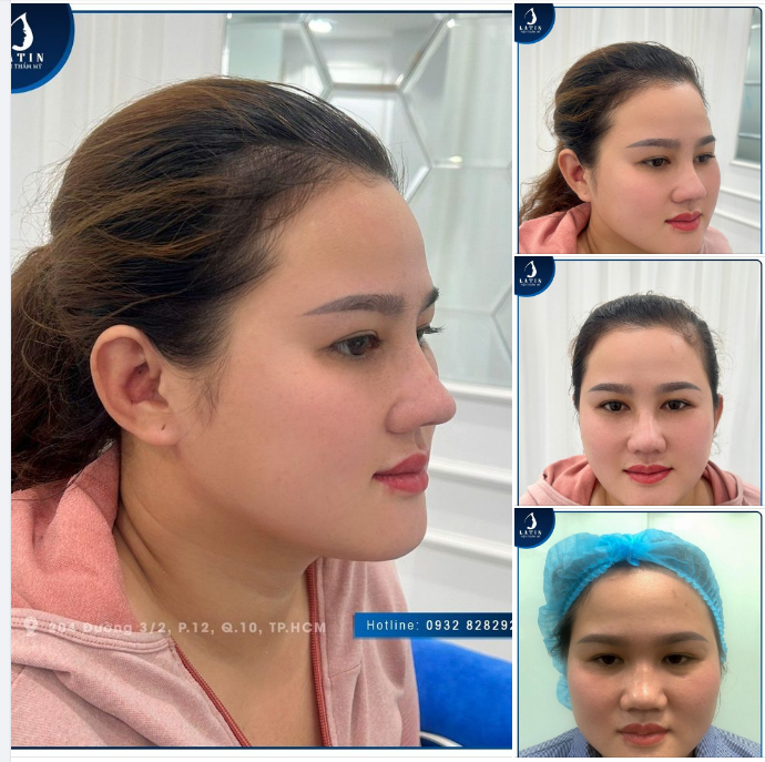 MŨI ĐẸP CHỈ SAU 7 NGÀY NÂNG MŨI