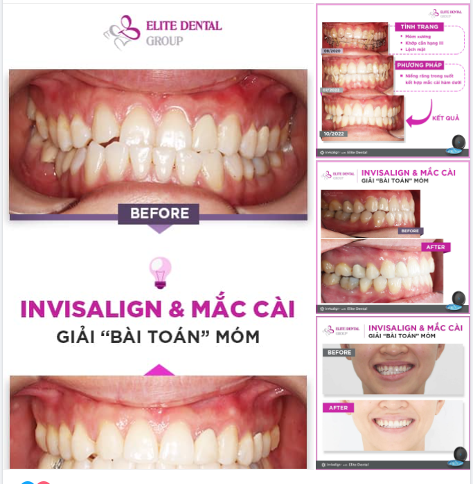 CẮN NGƯỢC, MÓM XƯƠNG, LẸCH HÀM, LỆCH MẶT