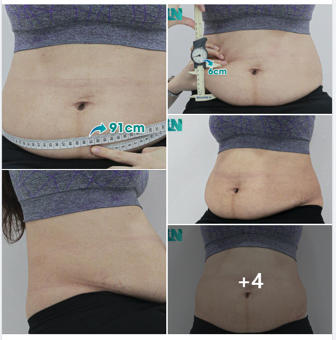 LẤY LẠI VÒNG EO SAU SINH CHO CHỊ KH 35 TUỔI, LỰA CHỌN GIẢM MỠ AN TOÀN.