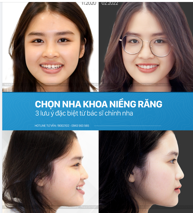 CHỌN NHA KHOA NIỀNG RĂNG BÍ QUYẾT & SAI LẦM CẦN TRÁNH
