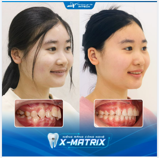 TỰ TIN VỚI HÀM RĂNG MỚI SAU 18 THÁNG NIỀNG RĂNG BẰNG CÔNG NGHỆ X-MATRIX