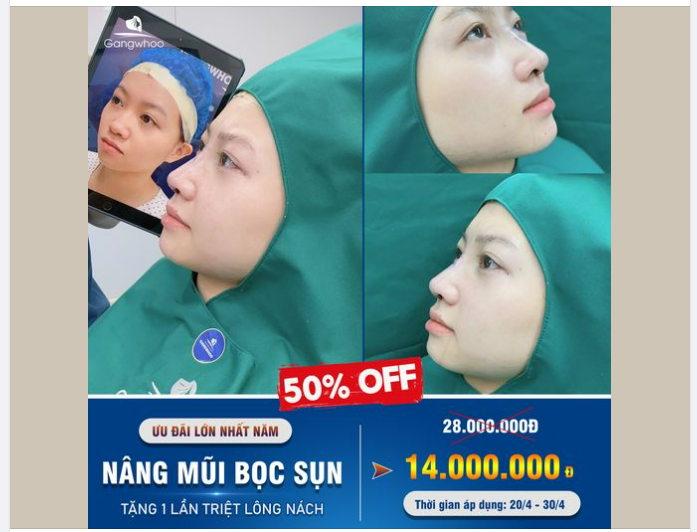 HOT! NÂNG MŨI BỌC SỤN - CÓ THẬT CHỈ 14 TRIỆU