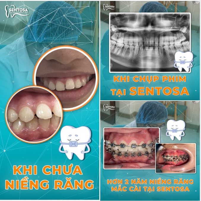 VÌ MỘT NỤ CƯỜI TỰ TIN Ở TƯƠNG LAI KHI NIỀNG RĂNG MẮC CÀI TẠI SENTOSA