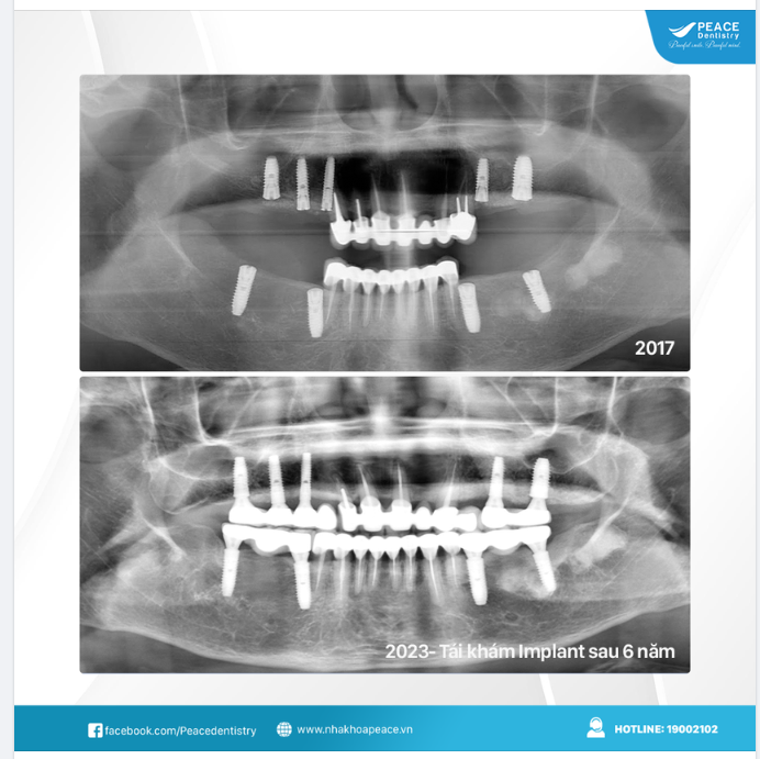 TÁI KHÁM TRỒNG RĂNG IMPLANT SAU 6 NĂM