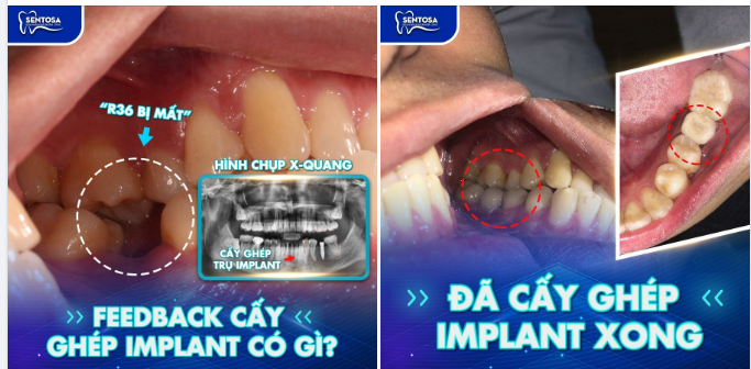 CẤY GHÉP IMPLANT  NỤ CƯỜI ĐẸP, ĂN NHAI TỐT
