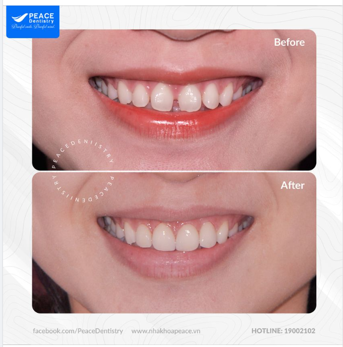 THIẾT KẾ NỤ CƯỜI MỚI