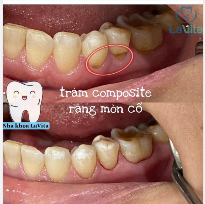 TÌM HIỂU VỀ BỆNH LÝ MÒN CỔ RĂNG VÀ CÁCH ĐIỀU TRỊ