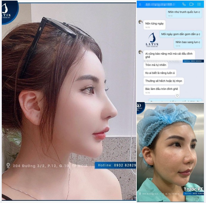 Feedback nhan sắc thăng hạng sau khi nâng mũi tại Latin