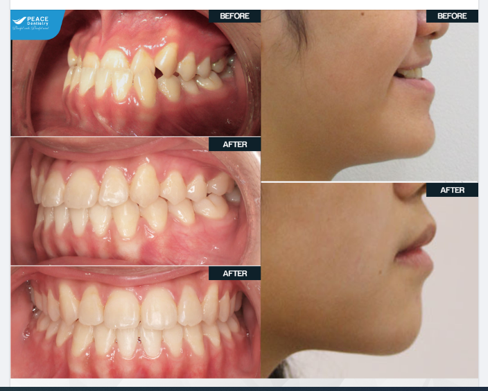 Thăng hạng nhan sắc nhờ niềng răng chỉnh móm