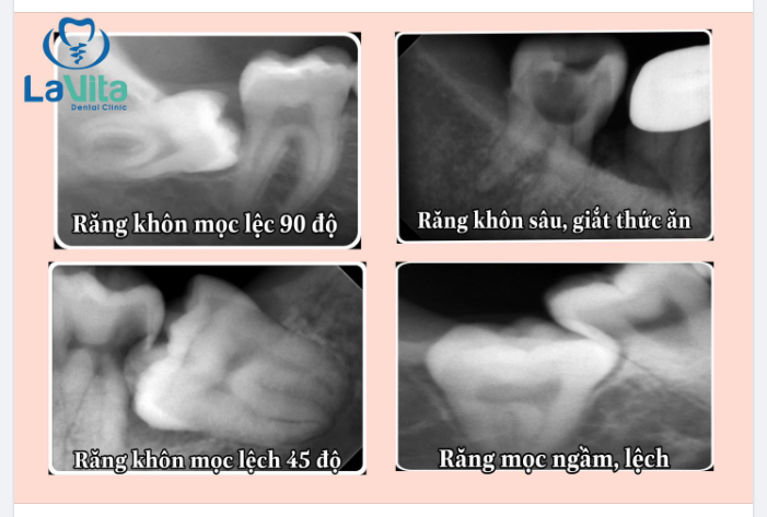KHI NÀO NÊN NHỔ RĂNG KHÔN?
