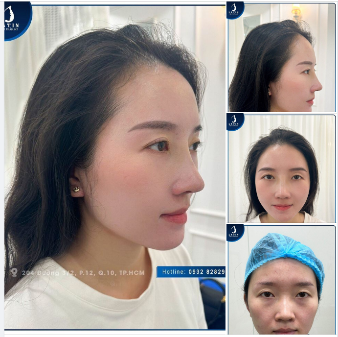 MŨI THẤP TẸT THAY ĐỔI THẾ NÀO SAU KHI NÂNG?